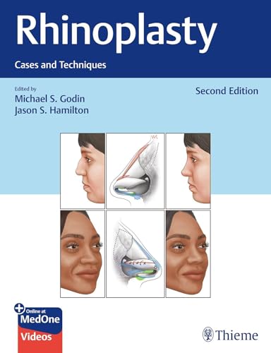 Rhinoplasty Cases and Techniques